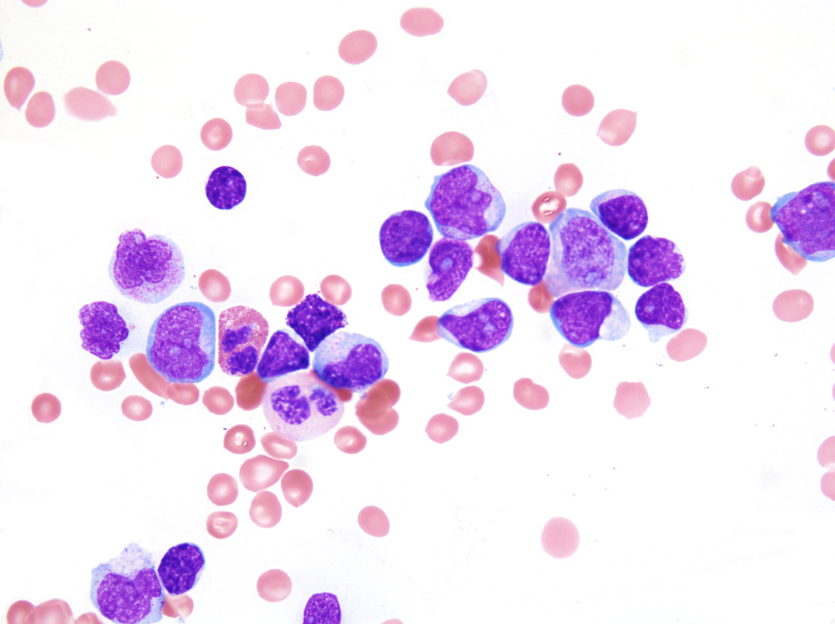3. Aspirate smear 100x oil